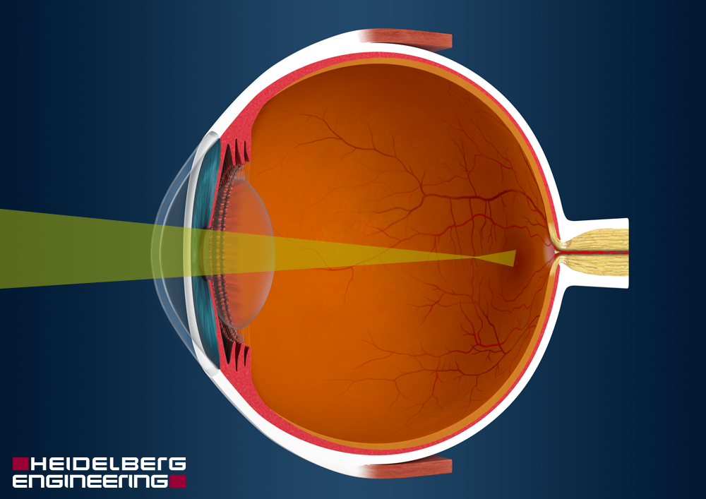 Vision Impairment Myopia Hyperopia Presbyopia